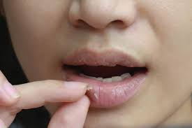 here is how to get rid of chapped lips