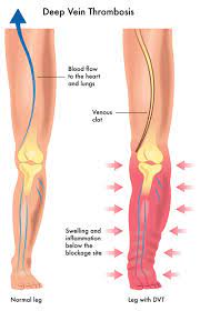 They can come on suddenly and then get worse fairly quickly. Acute Dvt Treatment Vascular Institute Of The Rockies