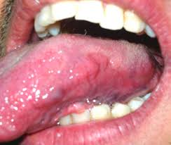 tongue lesion after surgery lateral