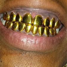 Get your grillz now, pay later. 22k Gold Permanent Crowns