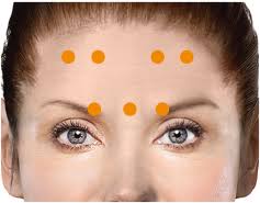 Chronic Migraine Injection Sites Botox