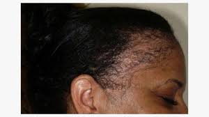 hair loss alopecia causes symptoms