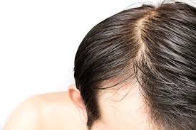 oily scalp treatment essential