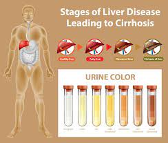 free vector ses of liver disease