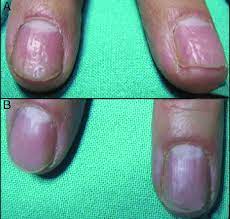 a nail matrix psoriasis of the right