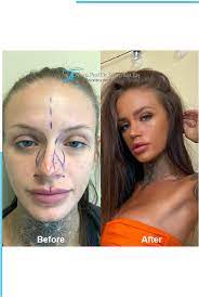 recover from a rhinoplasty