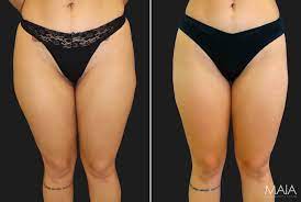 outer thigh liposuction maia