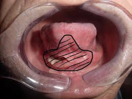 anterior mouth floor and ventral tongue