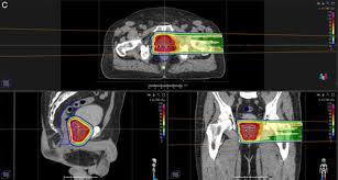 proton therapy using rectal spacers