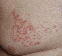 Granuloma annulare is a condition that causes expanding bumps on the skin that are reddish or flesh colored. Disseminated Granuloma Annulare Responsive To Narrowband Ultraviolet B Therapy Journal Of The American Academy Of Dermatology
