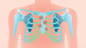 rheumatoid arthritis chest and rib