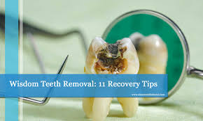 wisdom teeth removal 11 recovery tips