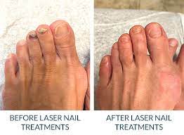 toenail fungus treatment in upper east