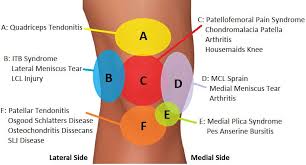 Knee Pain Diagnosis Chart Knee Pain Explained