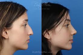 what rhinoplasty cost to expect in new