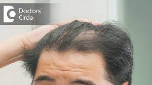 dry hair with hairfall after minoxidil