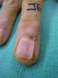 treatment of mucous cyst in a finger at
