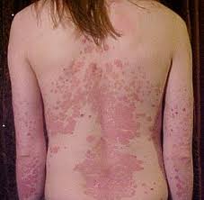 Stress, alcohol, and other triggers. Psoriasis Wikipedia