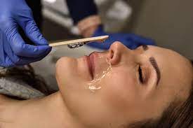 upper lip laser hair removal a