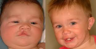 cleft lip palate and cranio