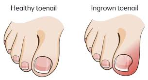 ingrown toenail removal drogheda