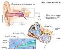 Image of Noiseinduced hearing loss