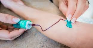 Butterfly Needle For Blood Draw How It Works And Why Its Used