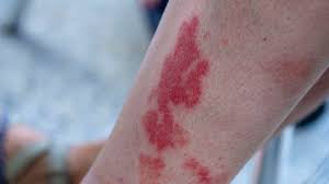 disney rash symptoms pictures