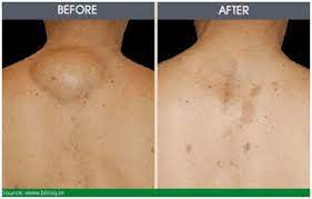 lipoma removal recovery time redefine