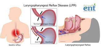 laryngopharyngeal reflux disease lpr