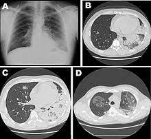Jul 02, 2009 · le pneumocoque est l'agent infectieux le plus fréquent et fait parti des deux germes les plus graves avec legionnella pneumophila (responsable de légionellose). Legionellose Wikipedia