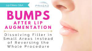 ps after lip augmentation