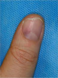 subungual glomus tumours of the hand