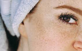 blepharitis from eyelash extensions and