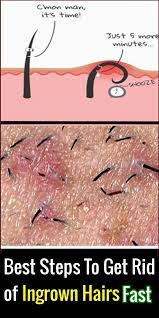 If you're one of those people, you're probably wondering how to get rid of that ingrown hair yourself—especially if you're social distancing at home thanks to the coronavirus. Best Steps To Get Rid Of Ingrown Hairs Fast Face Errors Ingrownhairs Hair Ingrown Ingrown Hair Hair Irritation Ingrown Hair Bikini
