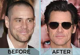 31 celebrities with hair transplant