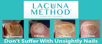 nail fungus treatment lacuna method