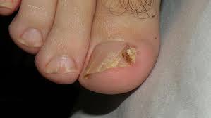 ingrown toenails finding a cure