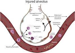 Acute respiratory distress syndrome (ards) is a form of acute lung injury, which is characterised by severe hypoxemia in the absence of a cardiogenic cause. Understanding The Role Of Neutrophils In Acute Respiratory Distress Syndrome Sciencedirect