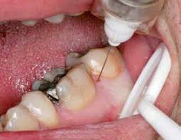 RÃ©sultat de recherche d'images pour "anesthÃ©sie intra septale dentaire"