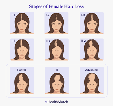 of women experience hair loss during