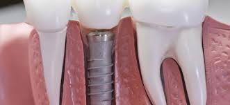 dental implants implant types