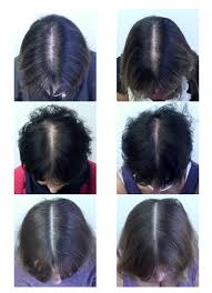 People use the seed oil, leaves, fruit, and flowers to make medicine. This Supplement Combo Reduced Hair Loss In 90 Of The Women Who Took It