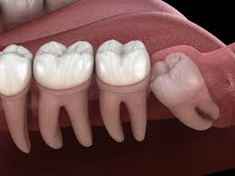 wisdom teeth removal the dentist of
