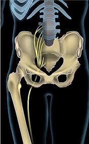 Sciatica Wikipedia