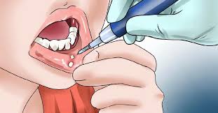 mouth ps mouth ulcers symptoms