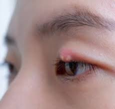 stye dry eye red eye lang eye clinic