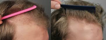he was started on finasteride and shortly after received a treatment of prp with acell