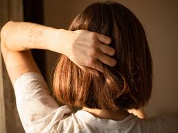 scalp eczema symptoms triggers and