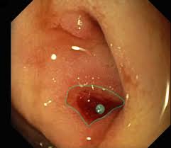 peptic ulcer disease knowledge amboss